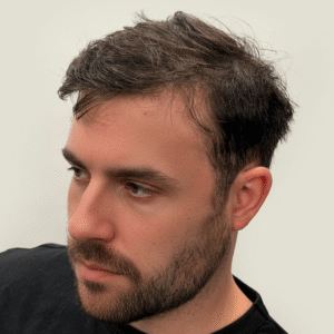 Jonas, 31, man, FUE hair transplant Chicago, 4,285 grafts, 2 sessions, before and after results
