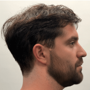 Jonas, 31, man, FUE hair transplant Chicago, 4,285 grafts, 2 sessions, before and after results