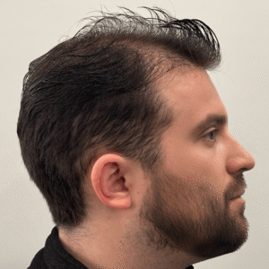 Jonas, 31, man, FUE hair transplant Chicago, 4,285 grafts, 2 sessions, before and after results