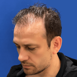 Larry, 39, man, revision FUE hair transplant Chicago, hairline, 2,916 grafts, before and after results