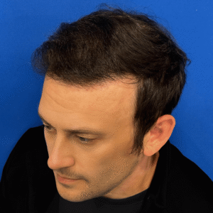 Larry, 39, man, revision FUE hair transplant Chicago, hairline, 2,916 grafts, before and after results