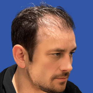 Larry, 39, man, revision FUE hair transplant Chicago, hairline, 2,916 grafts, before and after results