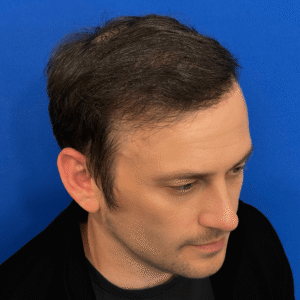 Larry, 39, man, revision FUE hair transplant Chicago, hairline, 2,916 grafts, before and after results