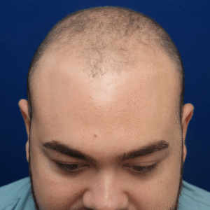 Marshall, 36, man, FUE hair transplant Chicago, hairline, before and after results