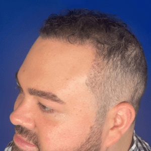 Marshall, 36, man, FUE hair transplant Chicago, hairline, before and after results