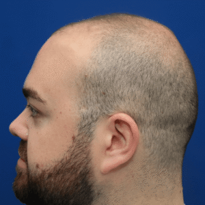 Marshall, 36, man, FUE hair transplant Chicago, hairline, before and after results