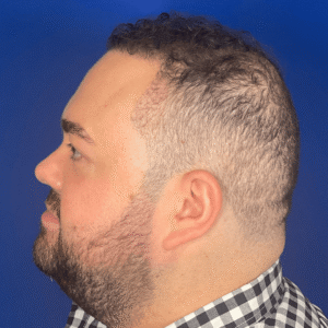 Marshall, 36, man, FUE hair transplant Chicago, hairline, before and after results