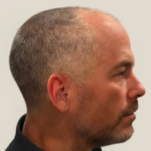 Nolan, 53, man, Micro PUE® hair transplant Chicago, hairline, 3,549 grafts, before and after pictures