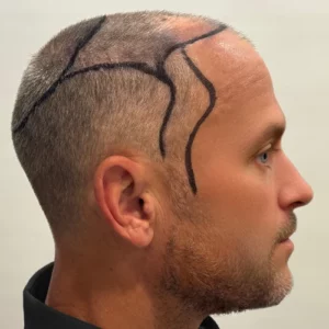 Nolan, 53, man, Micro PUE® hair transplant Chicago, hairline, 3,549 grafts, before and after pictures