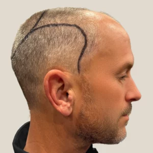 Nolan, 53, man, Micro PUE® hair transplant Chicago, hairline, 3,549 grafts, before and after pictures