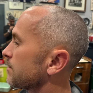 Nolan, 53, man, Micro PUE® hair transplant Chicago, hairline, 3,549 grafts, before and after pictures