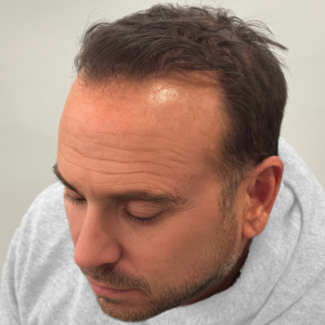 Ronan, 51, man, FUE hair transplant Chicago, hairline, 3,649 grafts, before and after results