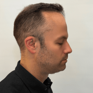 Silas, 49, man, revision Micro PUE® hair transplant Chicago, 3,464 grafts, 2 sessions, before and after pictures