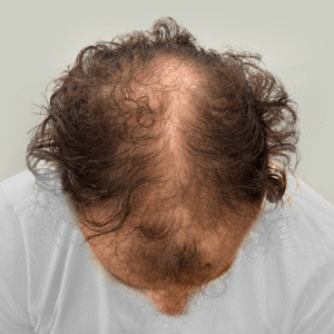 Zeke, 19, man, Micro PUE® hair transplant Chicago, hairline and crown, 6,924 grafts, mega session, before and after pictures