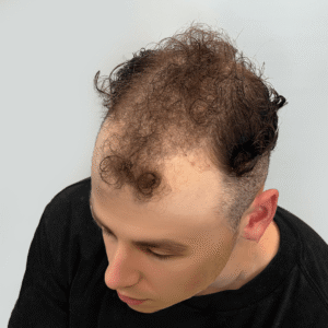 Zeke, 19, man, Micro PUE® hair transplant Chicago, hairline and crown, 6,924 grafts, mega session, before and after pictures