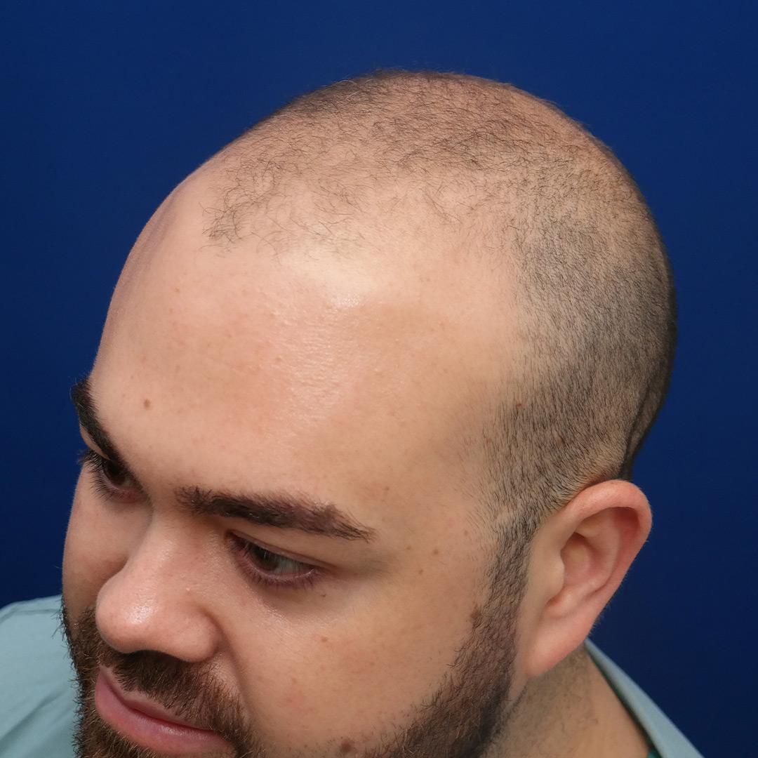 Marshall Before FUE Hair Transplant