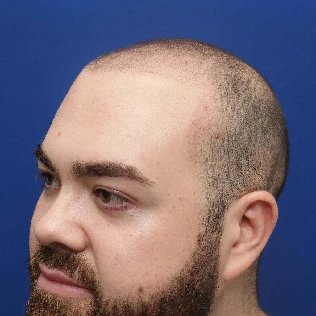 Marshall hair growth 1 months post-fue hair transplant pictures