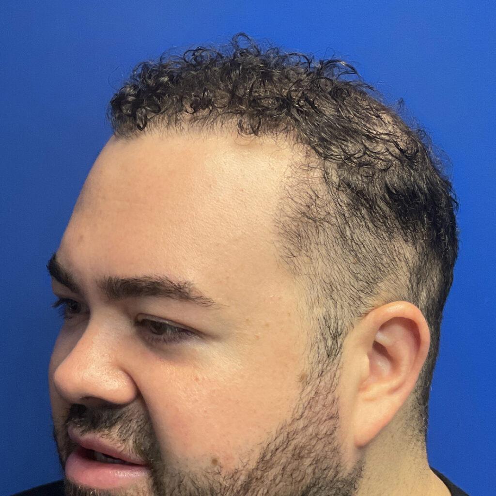 Marshall hair growth 12 months post-fue hair transplant