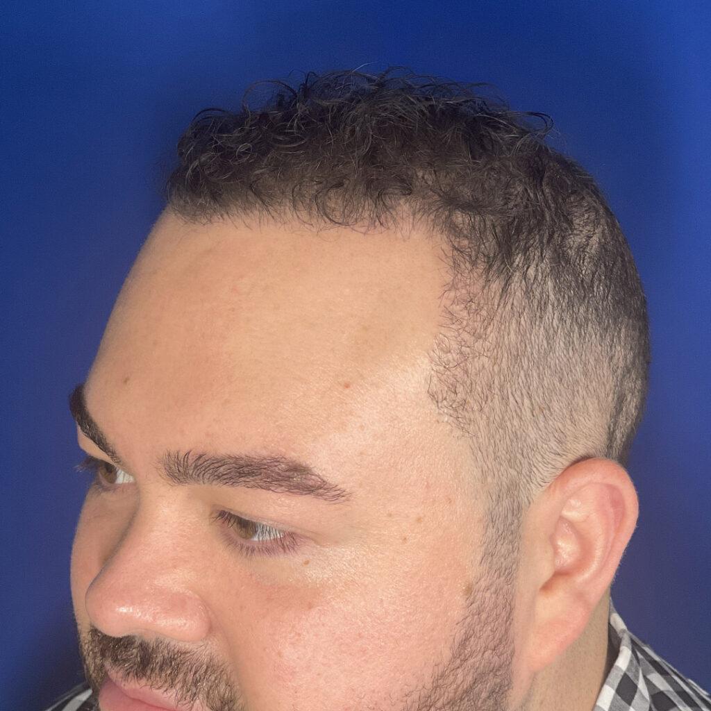 Marshall hair growth 18 months post-fue hair transplant pictures