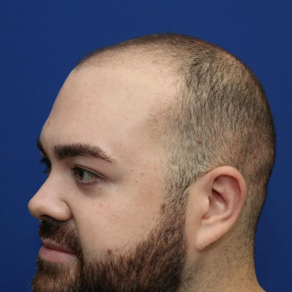 Marshall hair growth 3 months post-fue hair transplant pictures