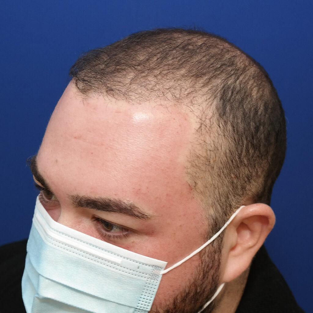 Marshall hair growth 6 months post-fue hair transplant pictures