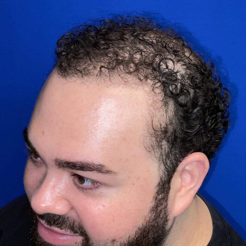 Marshall hair growth 9 months post-fue hair transplant pictures