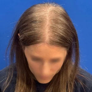 Brandy, 40, woman, non-surgical hair restoration Chicago, before and after pictures