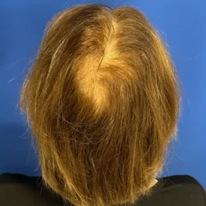 Bree, 80, woman, non-surgical hair restoration Chicago, before and after results