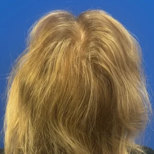 Bree, 80, woman, non-surgical hair restoration Chicago, before and after results