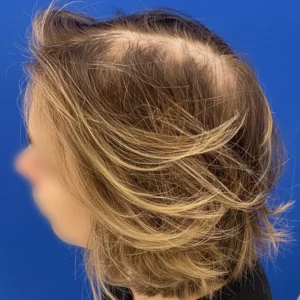 Bree, 80, woman, non-surgical hair restoration Chicago, before and after results