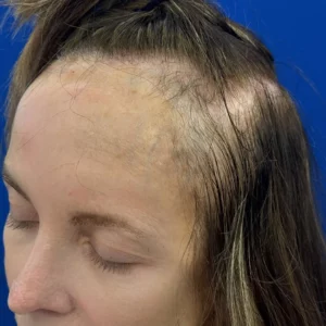Bree, 80, woman, non-surgical hair restoration Chicago, before and after results