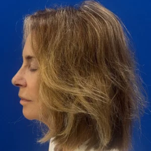 Bree, 80, woman, non-surgical hair restoration Chicago, before and after results