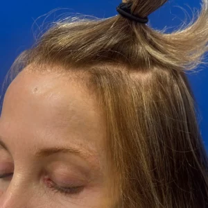 Bree, 80, woman, non-surgical hair restoration Chicago, before and after results