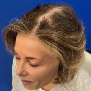 Bree, 80, woman, non-surgical hair restoration Chicago, before and after results