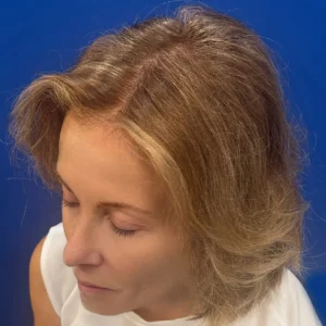 Bree, 80, woman, non-surgical hair restoration Chicago, before and after results