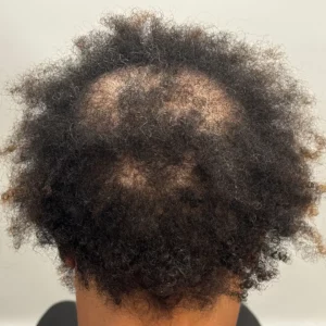 Cynthia, African American woman, non-surgical hair restoration Chicago, before and after results