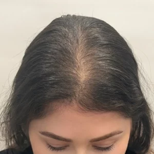 Gabriela, 45, Hispanic woman, non-surgical hair restoration Chicago, before and after results