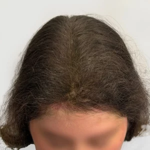 Gabriela, 45, Hispanic woman, non-surgical hair restoration Chicago, before and after results
