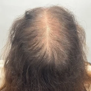 Gabriela, 45, Hispanic woman, non-surgical hair restoration Chicago, before and after results