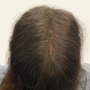 Gabriela, 45, Hispanic woman, non-surgical hair restoration Chicago, before and after results