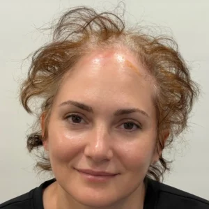 Rosa, woman, non-surgical hair restoration Chicago, before and after photos