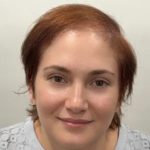 Rosa, woman, non-surgical hair restoration Chicago, before and after photos