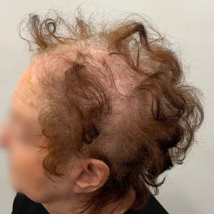 Rosa, woman, non-surgical hair restoration Chicago, before and after photos