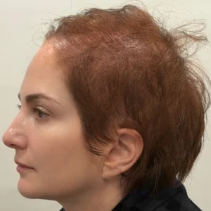 Rosa, woman, non-surgical hair restoration Chicago, before and after photos