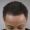 women's scalp micropigmentation for hair loss in Chicago