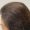 Women Tricholgy and Scalp Treatments Before and After Result