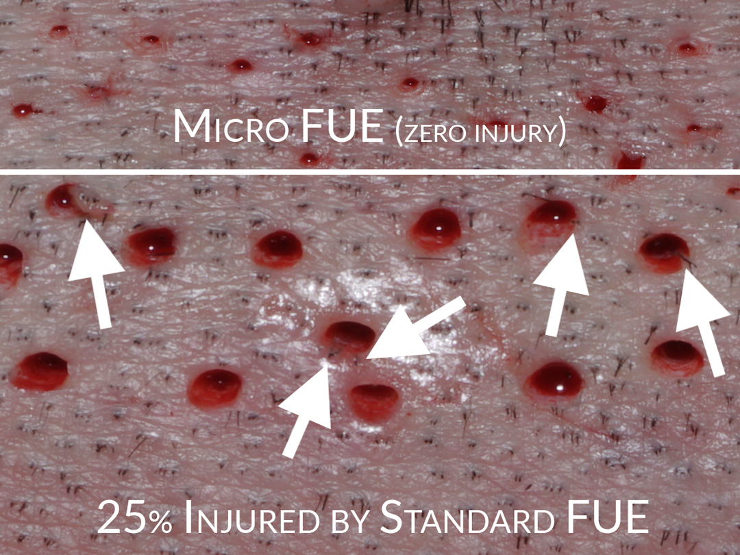 Damaged-by-FUE