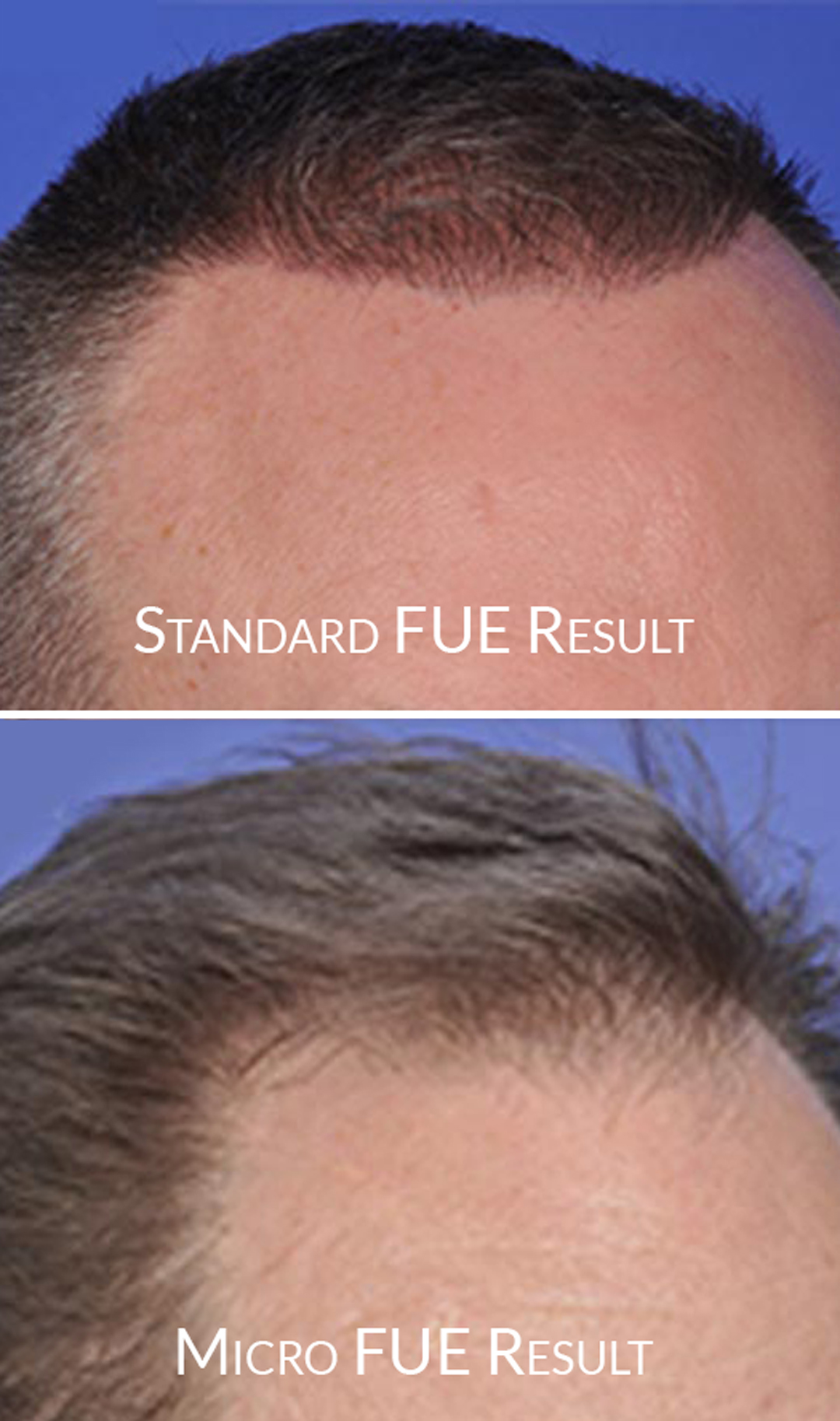 brown-hairline-fue-vs-micro-fue-top-bottom