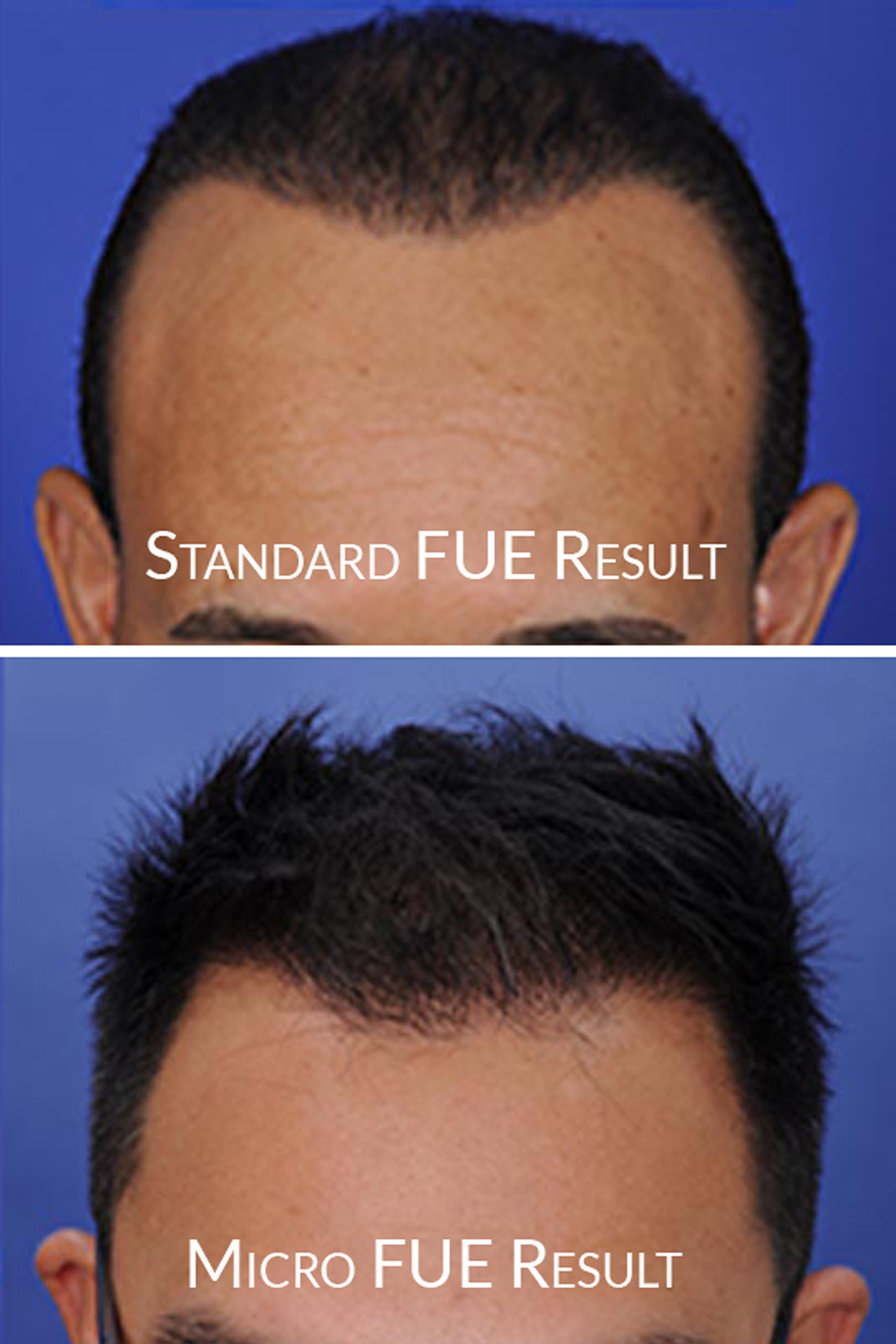 dark-hairline-fue-vs-micro-fue-top-bottom