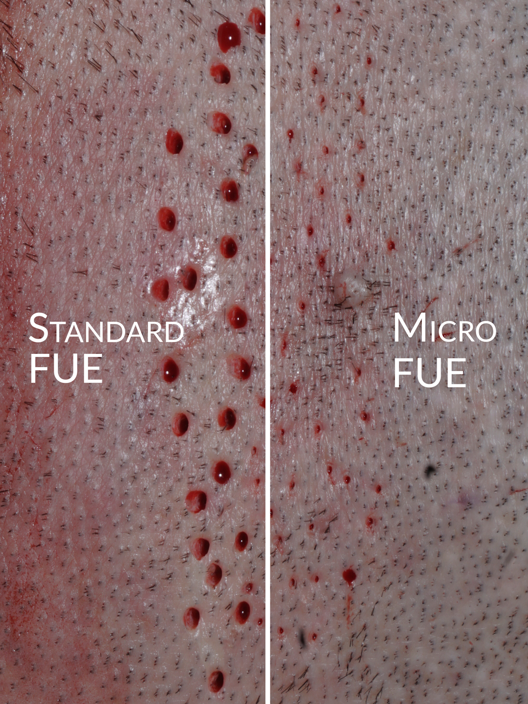 side-by-side--Back-of-Head-FUE-vs-microFUE-patient-2